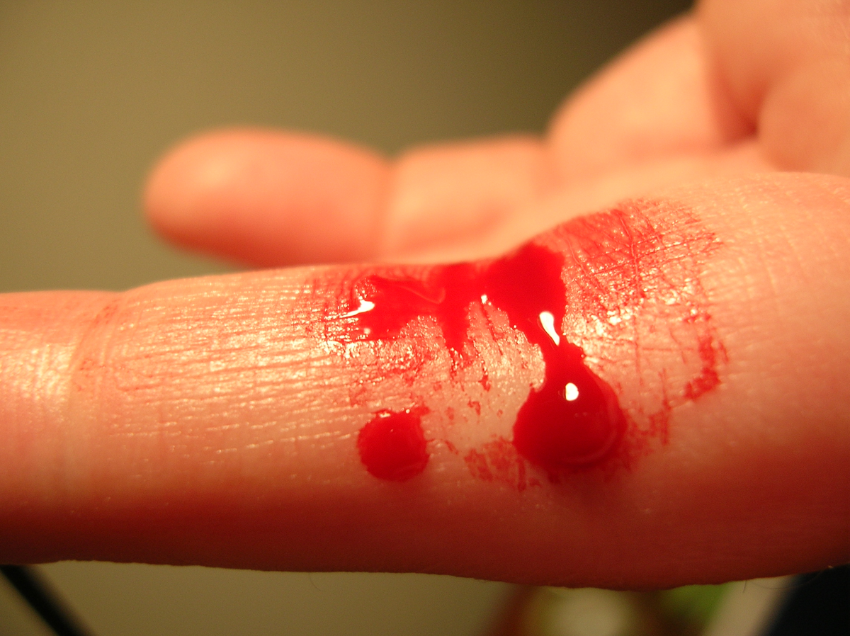bleeding finger