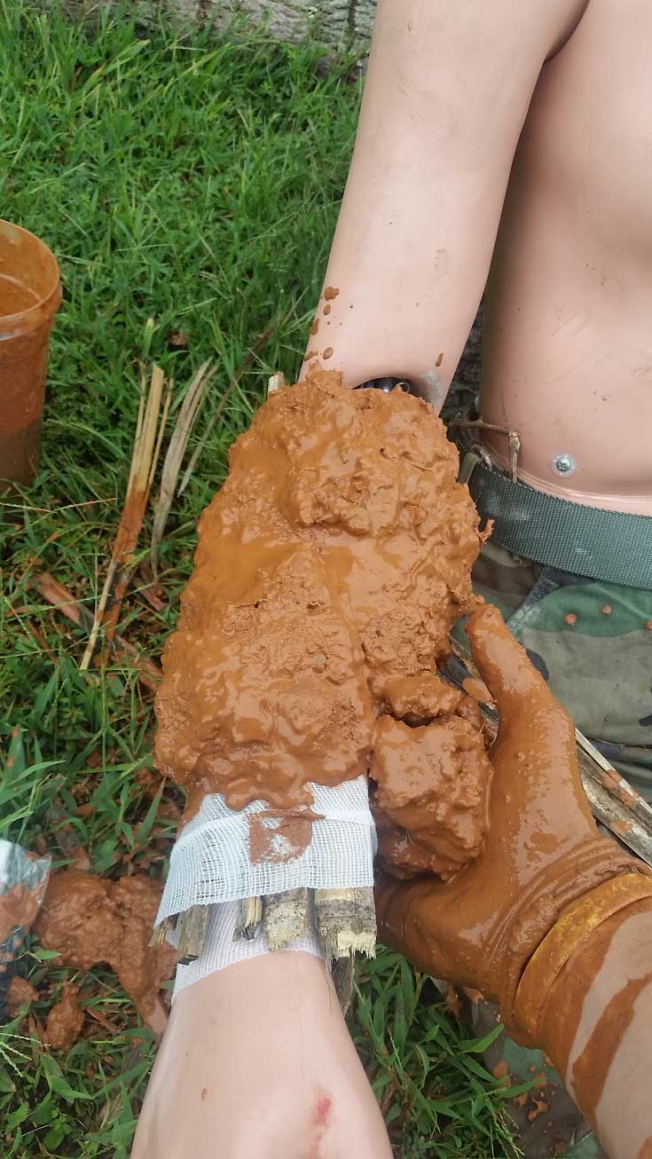 first aid mud cast