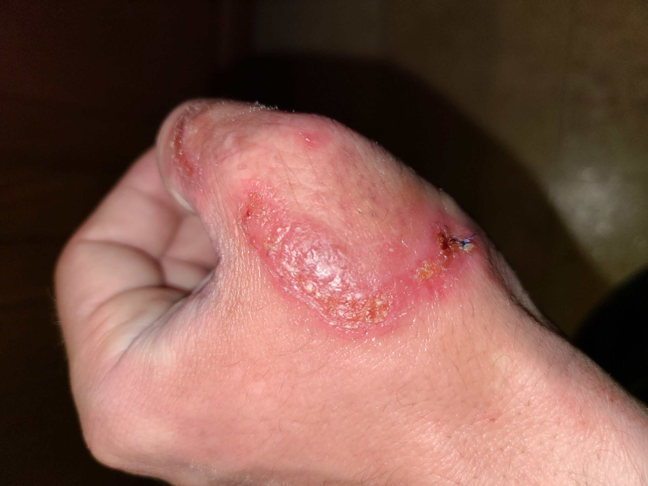 Fungal infection a hunter got from a coyote.