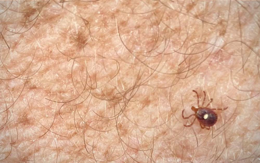 A tick embedded in someone's arm