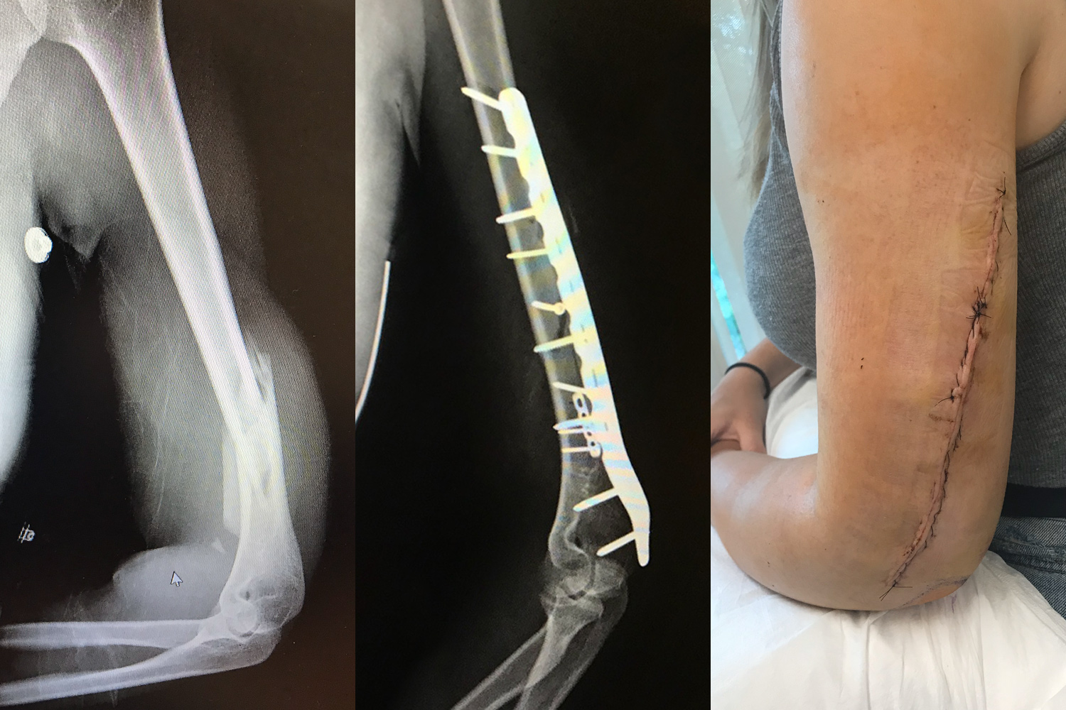 two arm x-rays and scar on arm