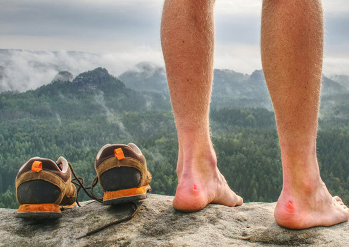 Should You Pop a Blister When Hiking?