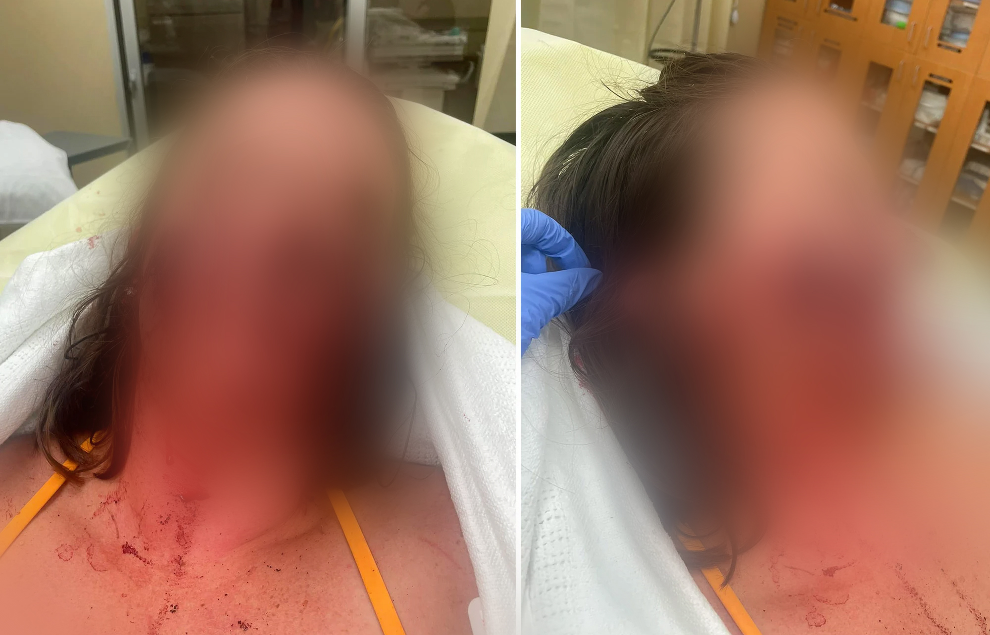 Woman attacked by a river otter in a hospital bed, with her face blurred.