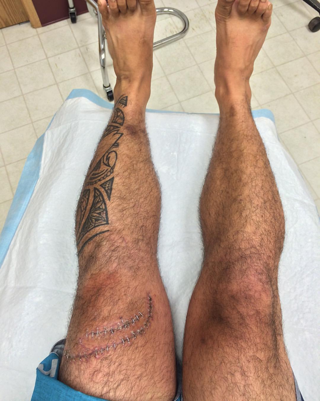 Braxton Rocha's legs after healing from the shark bite injuries.