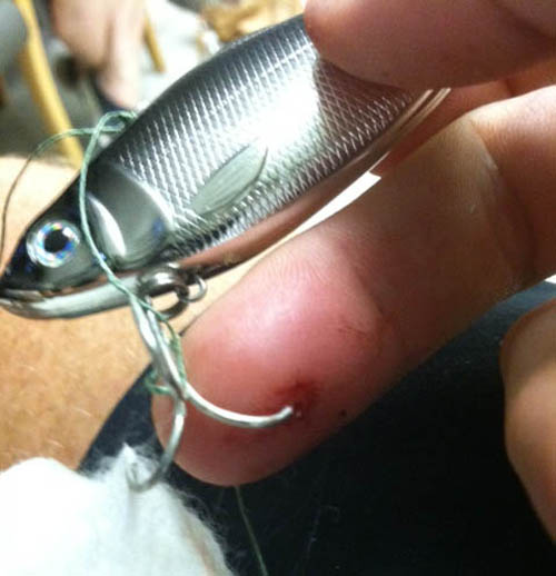 fish hook injury