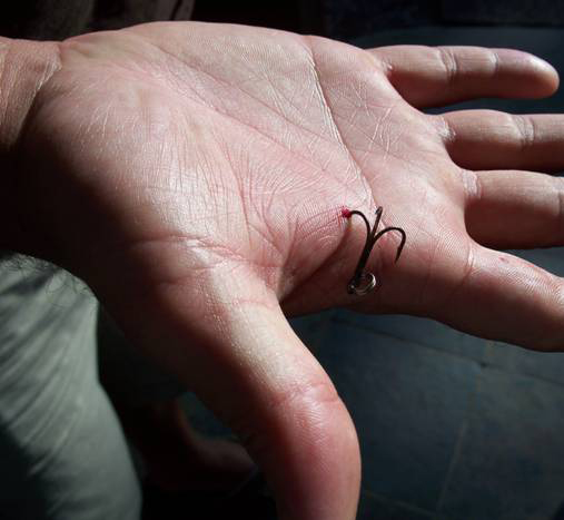 Nasty Hook Photos: How to Remove a Fish Hook and Treat the Injury