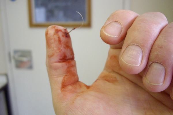 Nasty Hook Photos: How to Remove a Fish Hook and Treat the Injury
