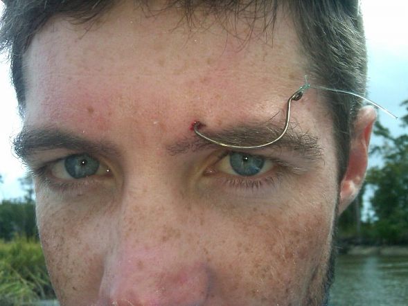 fishhook in eyebrow