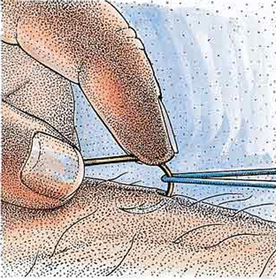 fish hook wound illustration