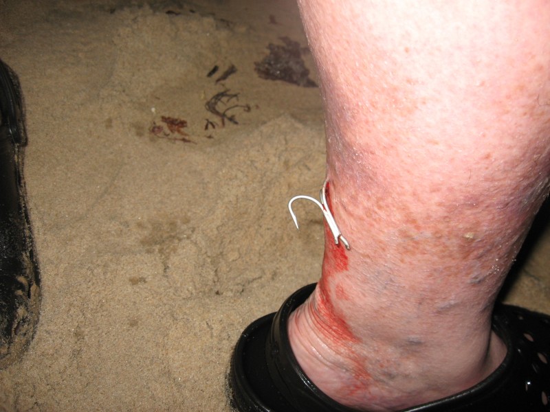 fishhook on leg