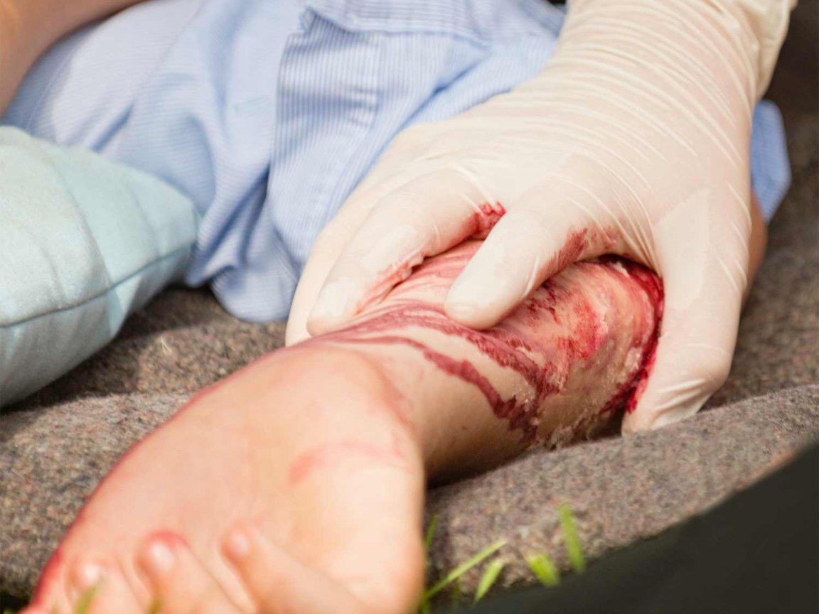 Treating a bloody injury