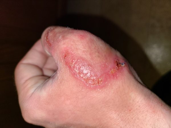 I Got This Nasty, Flesh-Eating Fungal Infection from a Coyote