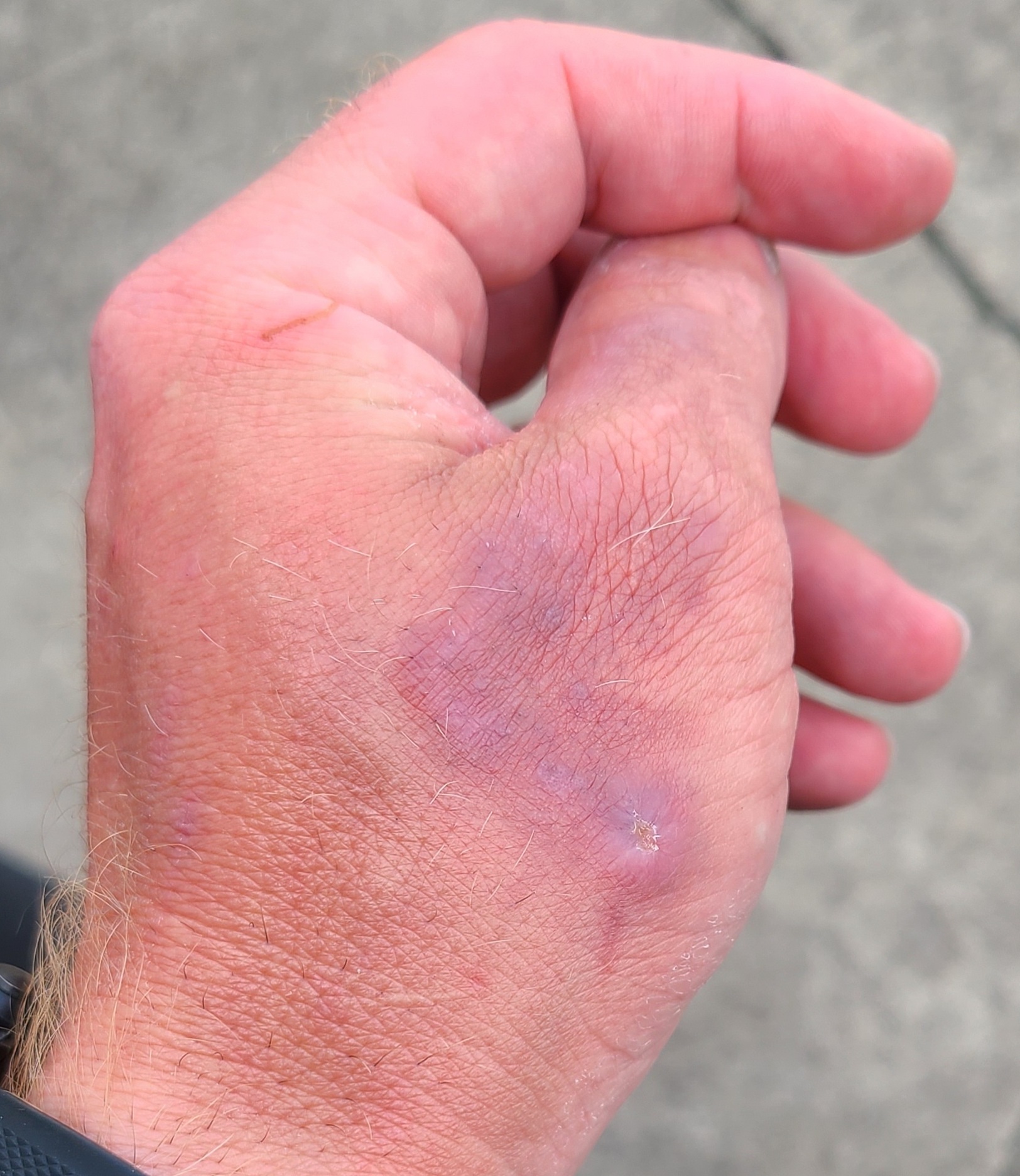 Healed ringworm on a coyote hunter's hand.