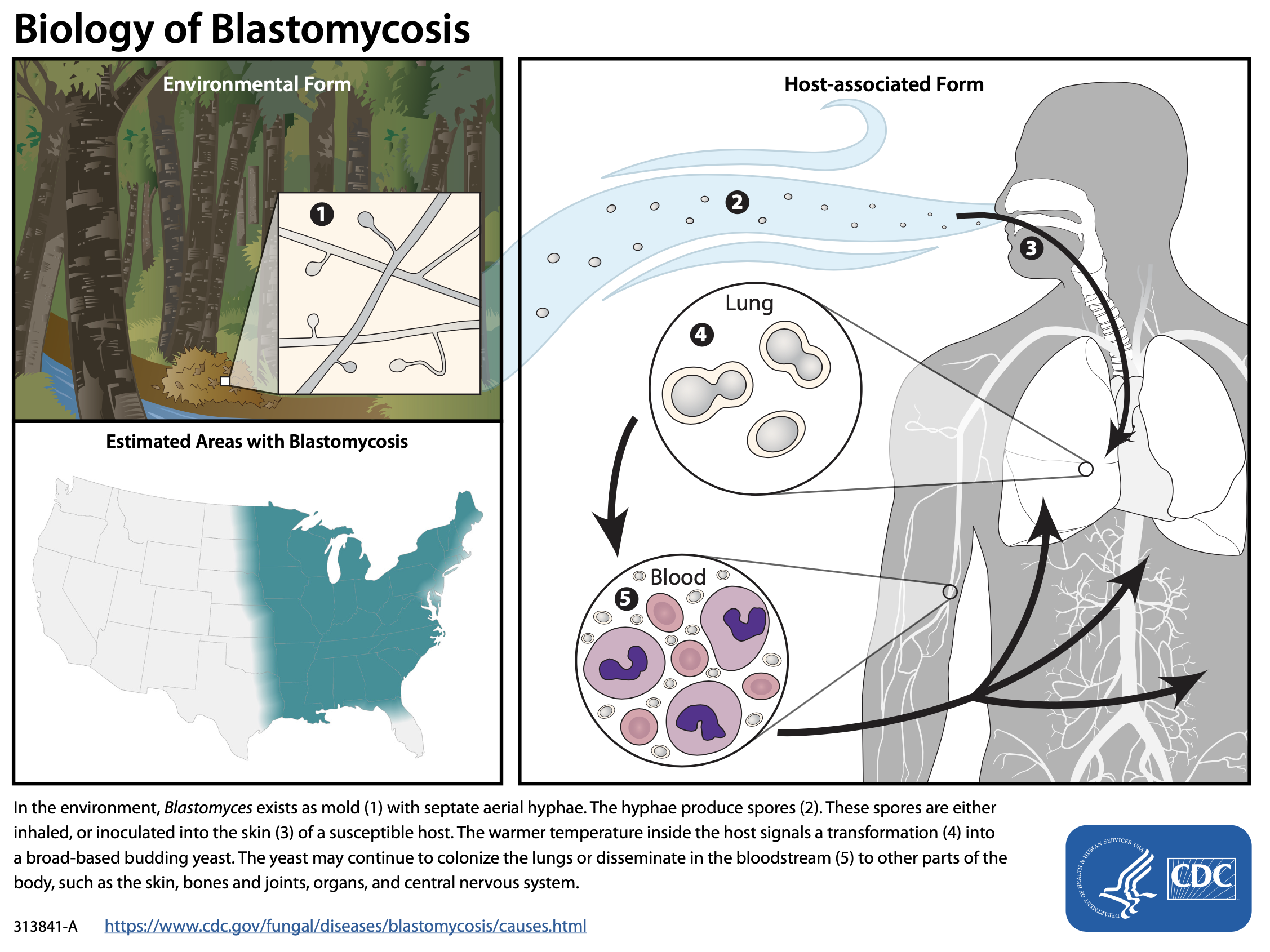 Blastomycosis can develop after humans or other mammals inhale fungal spores.