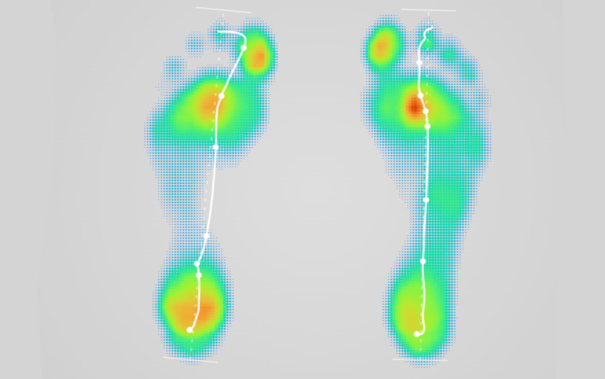 The pressure I place on my feet while walking is indicated here (red being the most pressure and blue being the least). The lines show my foot angle and direction while walking.