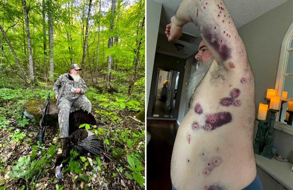 Takeaways from a Turkey Hunter Who Was Accidentally Shot by His Longtime Hunting Partner