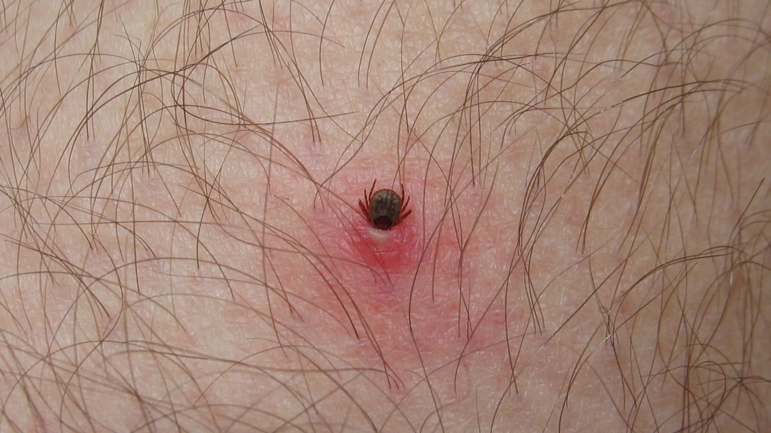 Tick Bite Symptoms Outdoor Life Tick Bite Symptoms Outdoor Life