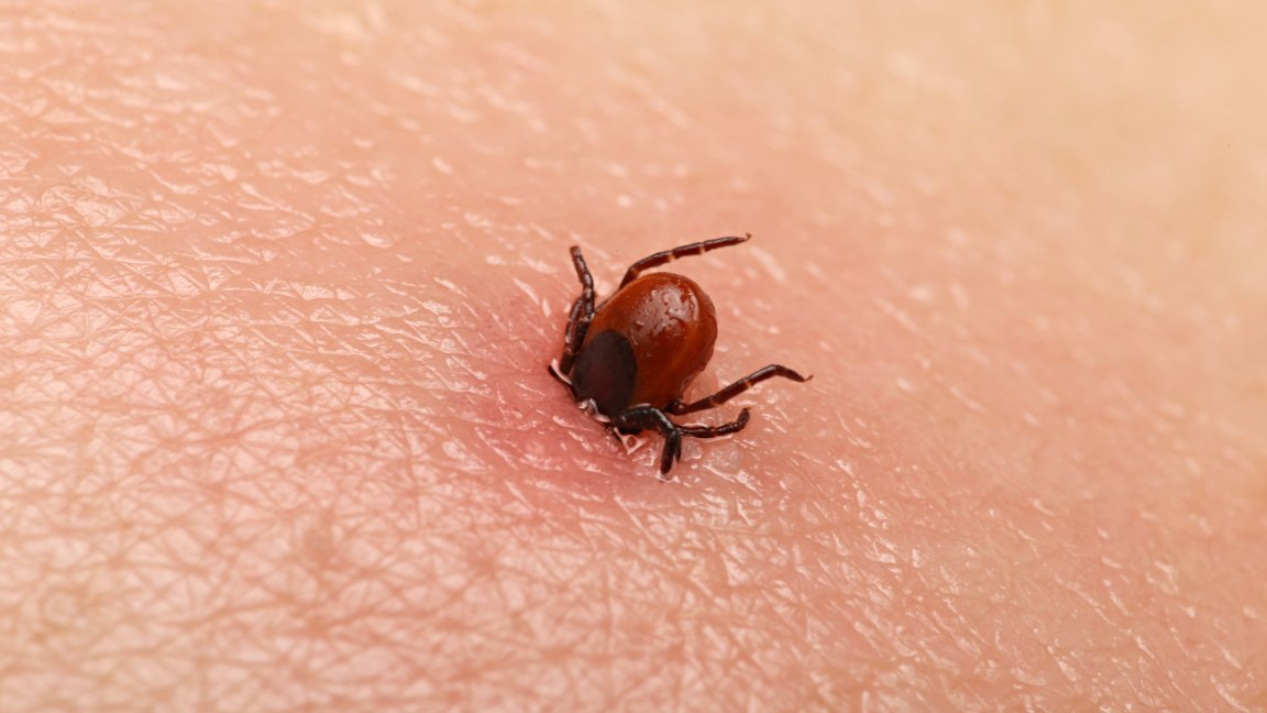 tick embedded in skin