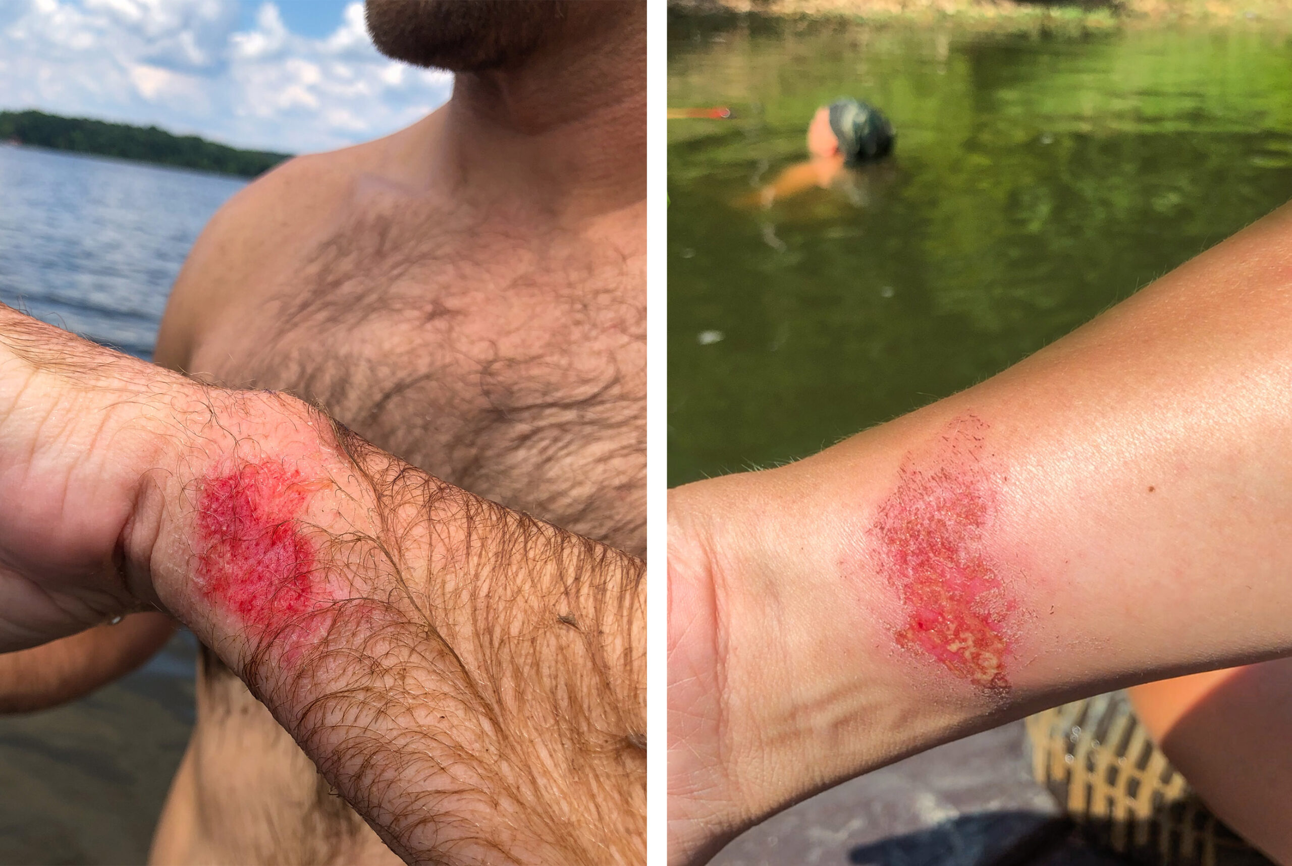 Examples of wrist rash sustained while noodling