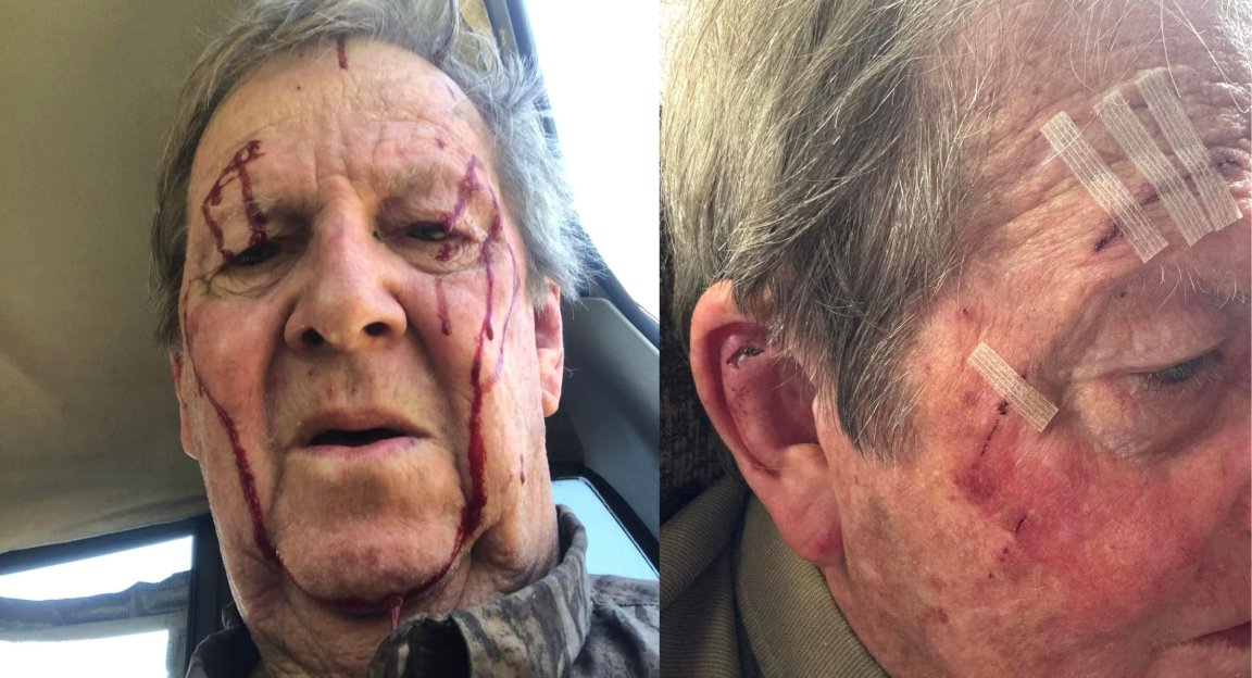 Side by side images of a man with a bloodied face and with his injured face bandaged.