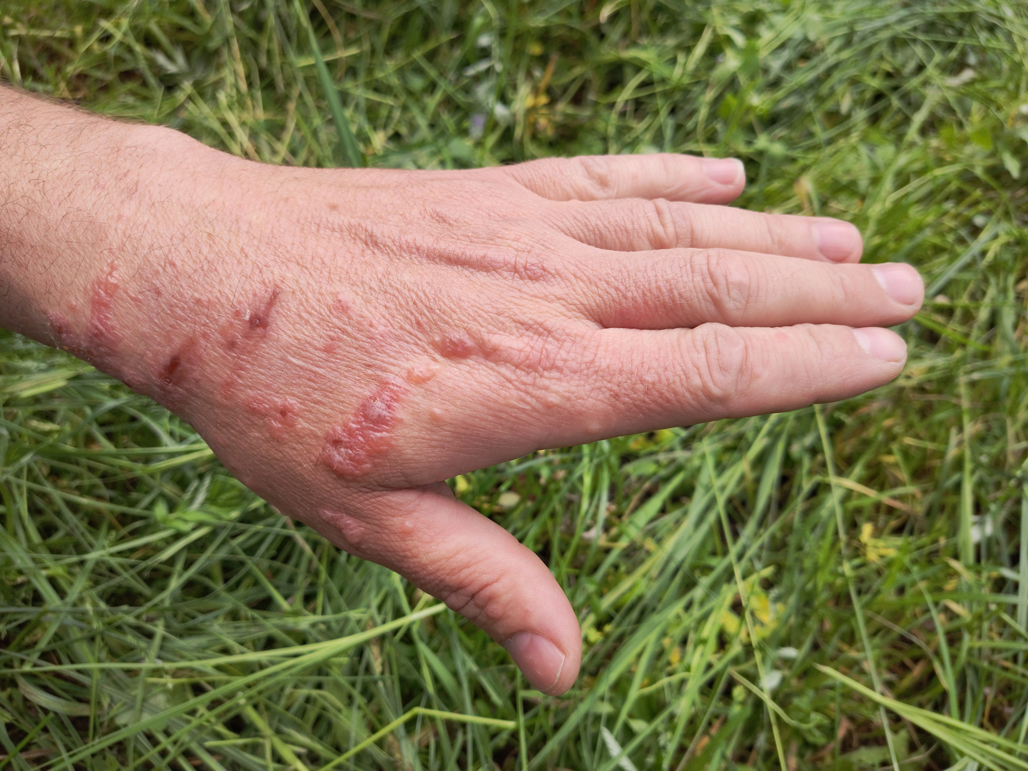 Hogweed burns on a man's hand.