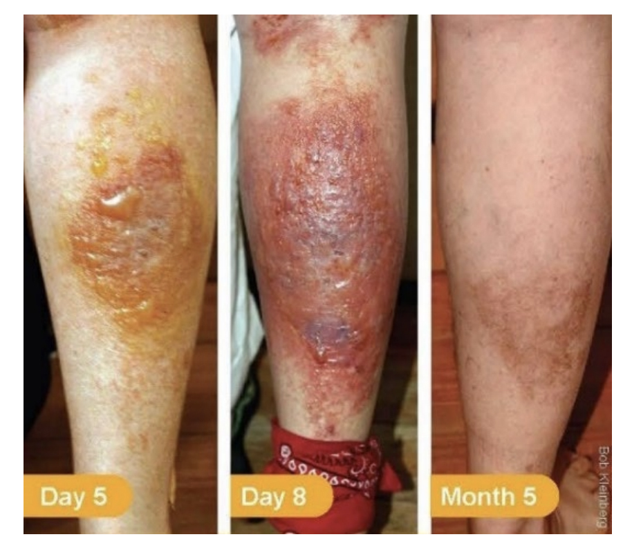 Calves with extreme hogweed burns