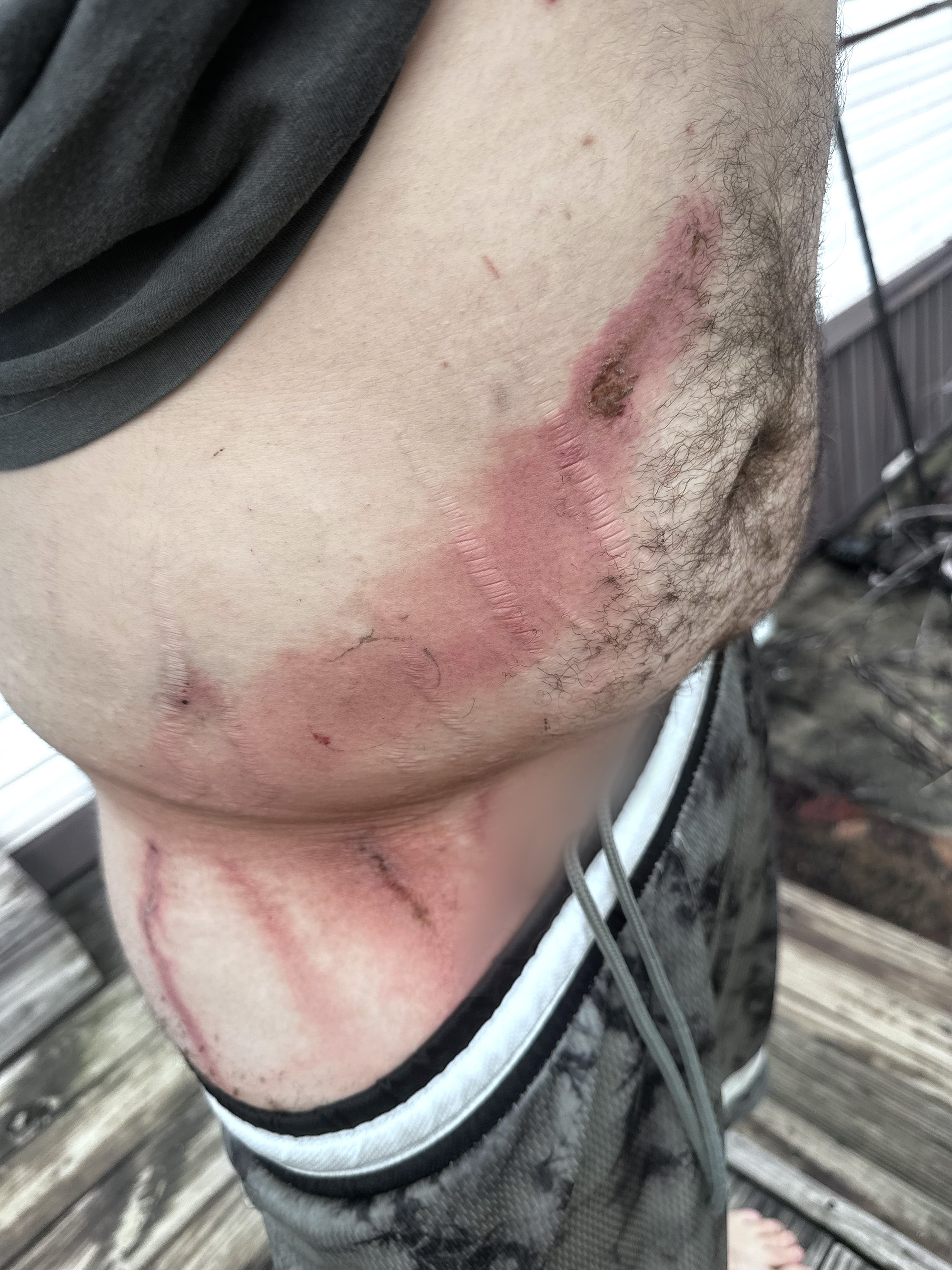 An angler's scarred stomach after a lightning strike.