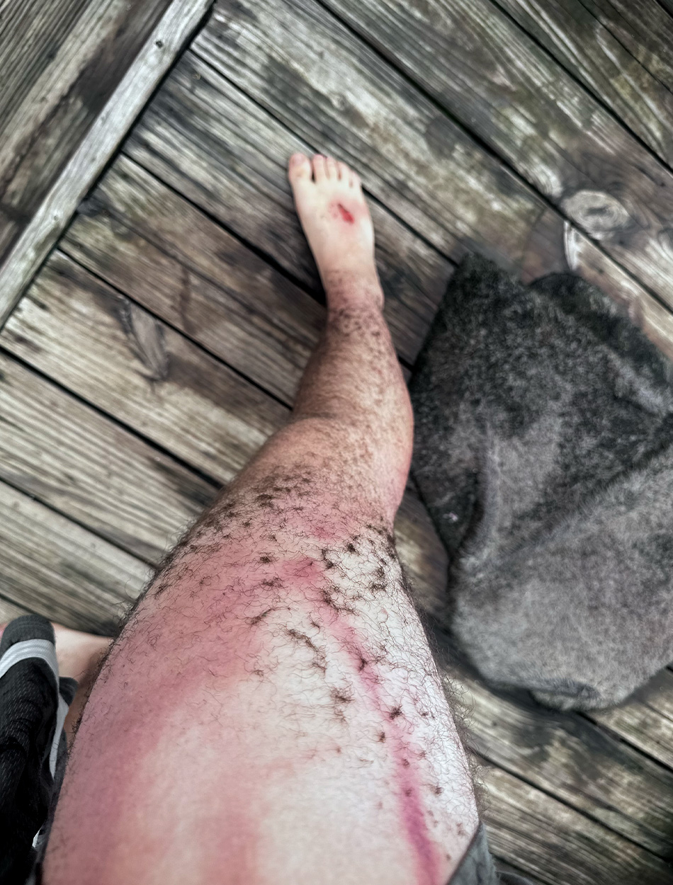 An angler's leg after being struck by lightning.