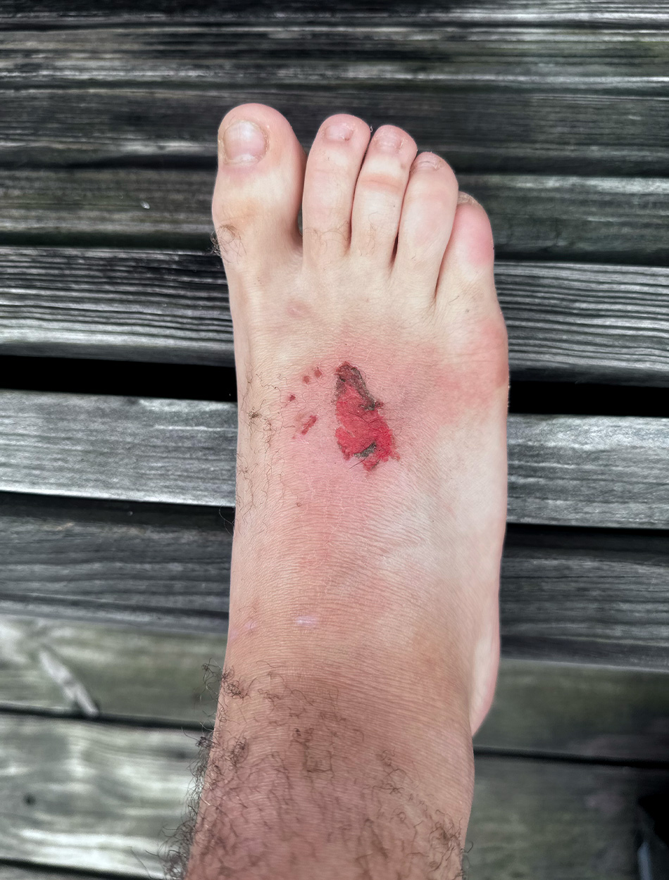 An angler's foot after being struck by lightning.