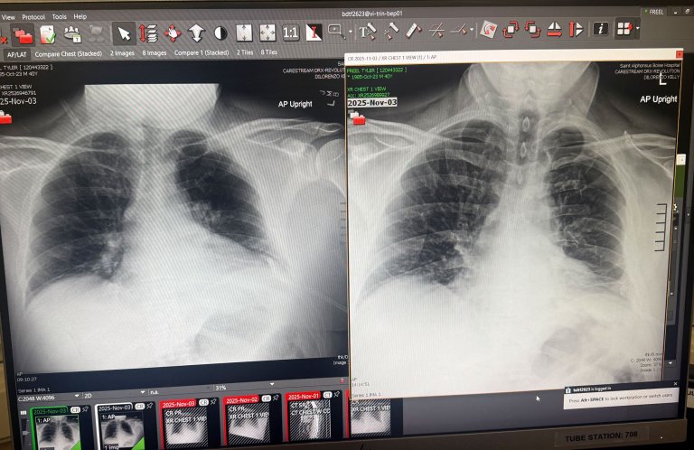 Freel Chest X-Ray